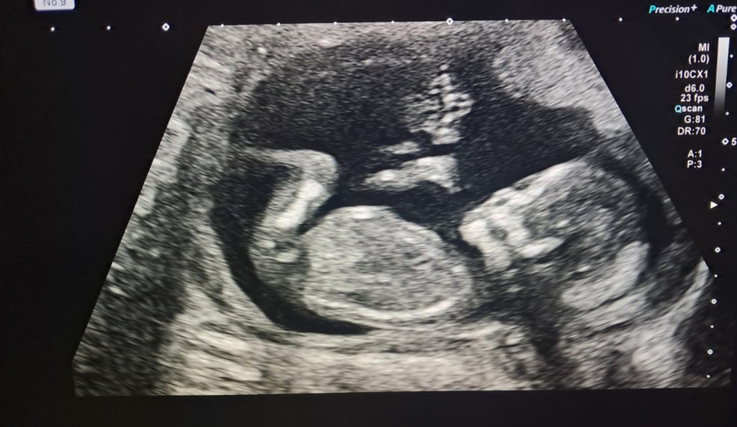 Gender guesses/help from ultrasound