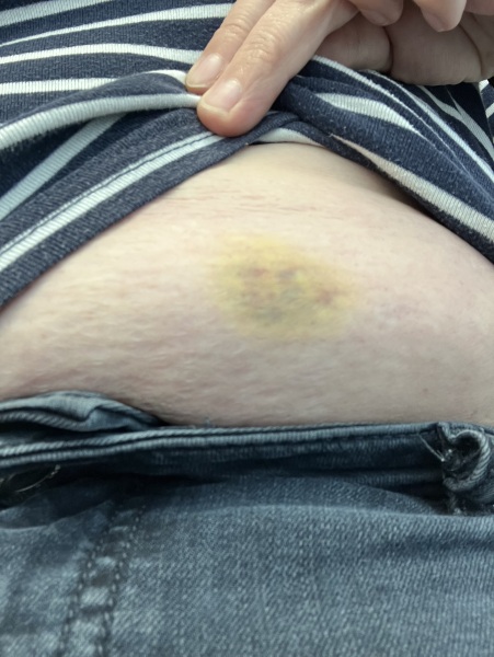 Slow losers club! (Ozempic, wegovy, mountjaro etc)