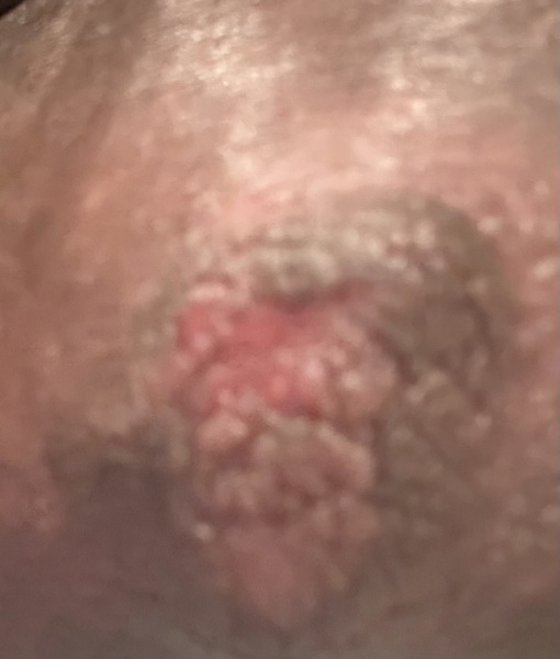 Pics of Nipple Warning! Day 3 of breastfeeding and have this on one breast