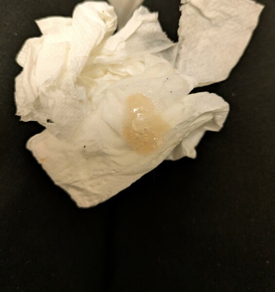 Is what I coughed up blood tinged?! (Photo) Virus/Asthma