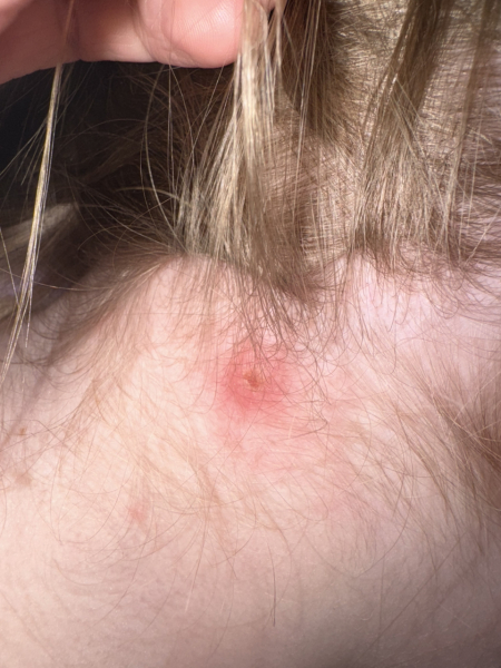 Is this Chicken Pox or more serious?