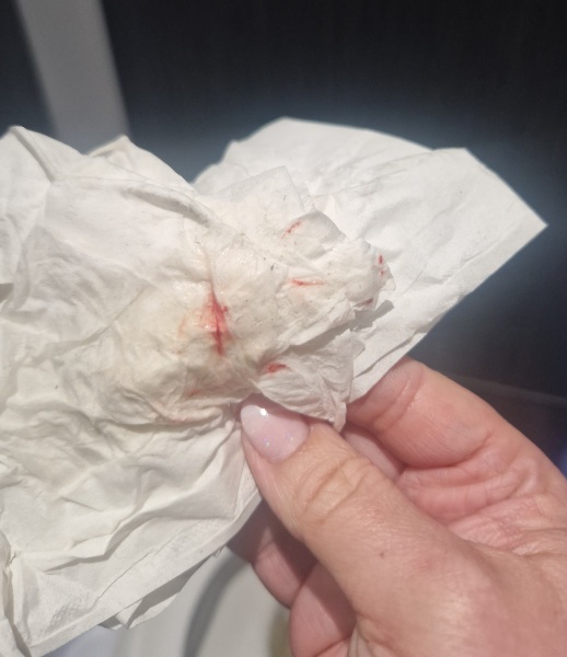 Implantation bleeding