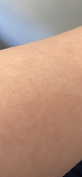 Red freckles/speck of blood