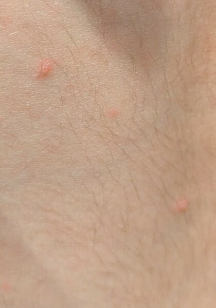 Chicken pox or bug bites?