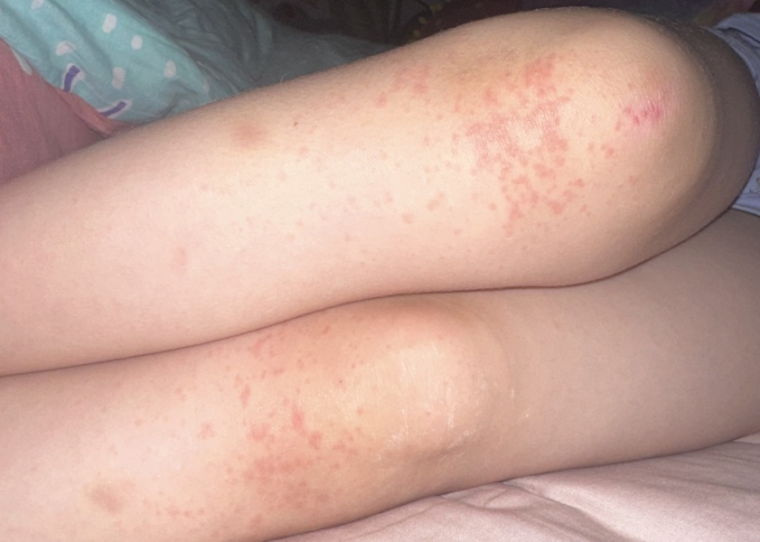 Could anyone advise what this rash could be please?