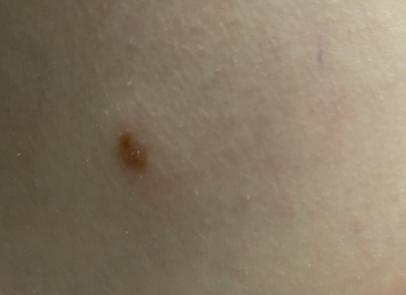 Could this be skin cancer? Really scared!