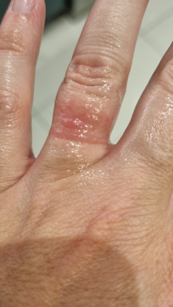 My finger is so sodding sore