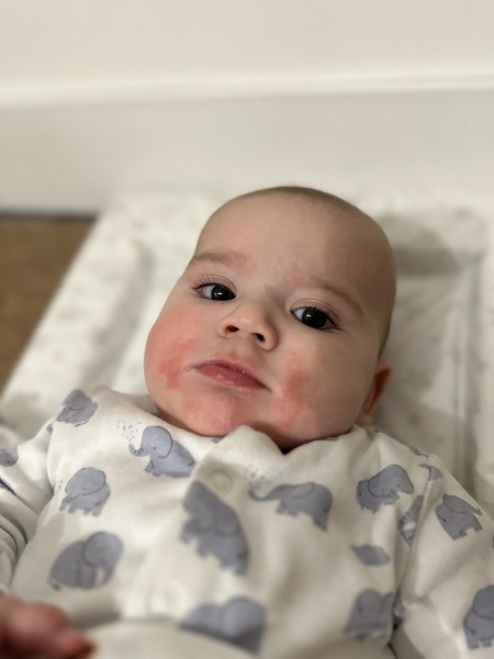 Rash - is it allergy? Ezcema? Or teething?