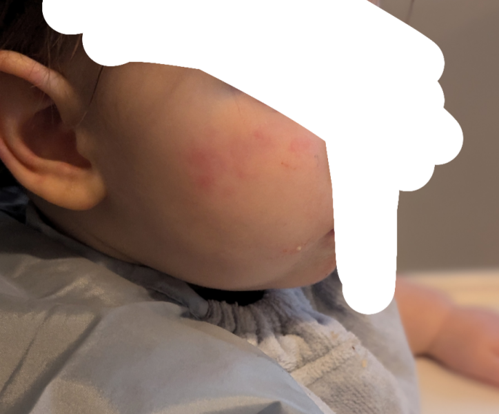 Rash on face from teething?