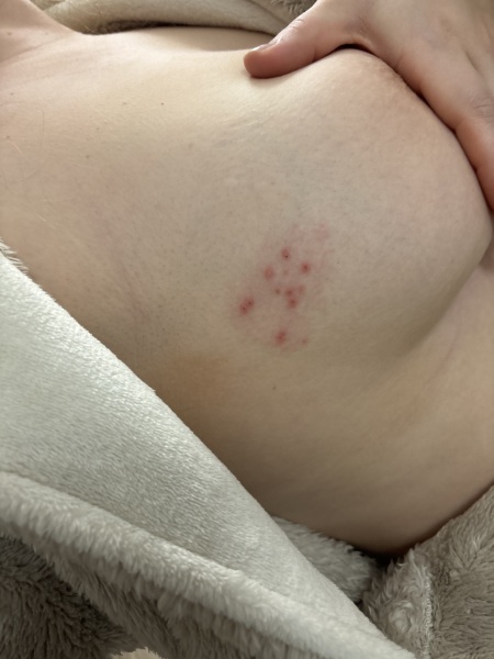 Has anyone had a rash like this, I’m panicking!