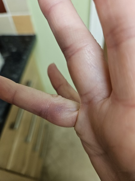 Painful vein suddenly appearing on fingers/hands