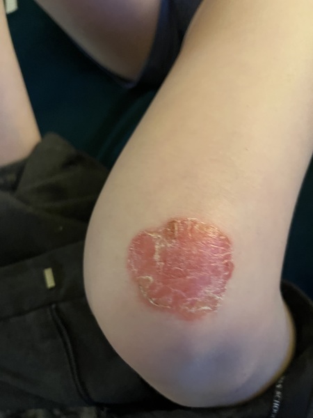 Does this wound look infected? Do I need to seek help tonight?