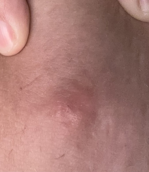 Don't know if I should keep trying to pop this??!