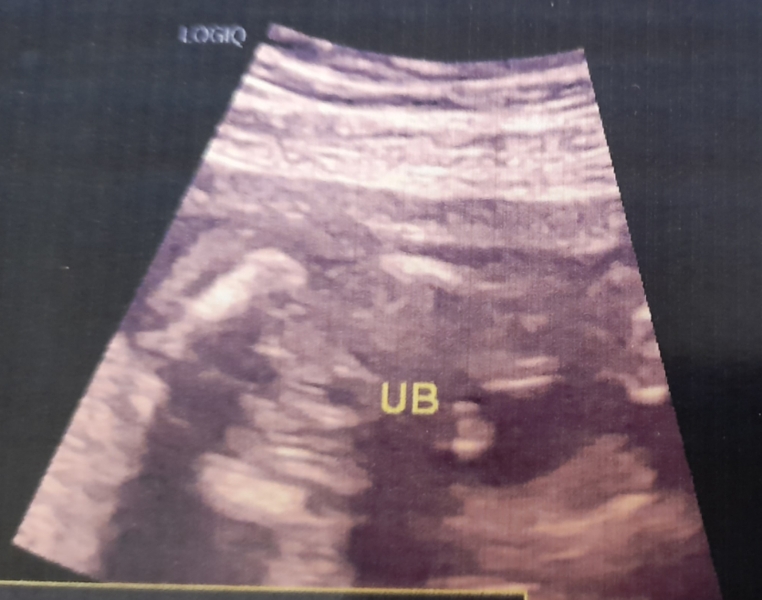 Guess the gender: boy or swollen girl.