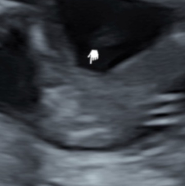 Babies Gender potentially wrong