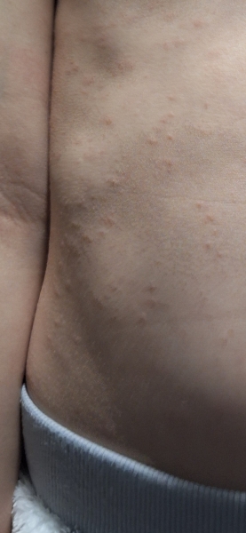 What does this rash look like?