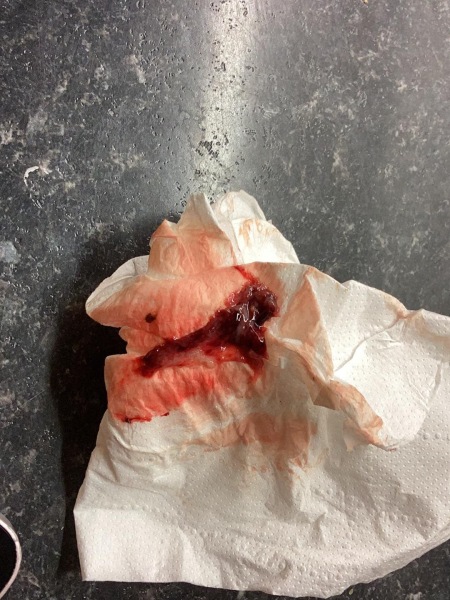 Bleeding at 8 weeks