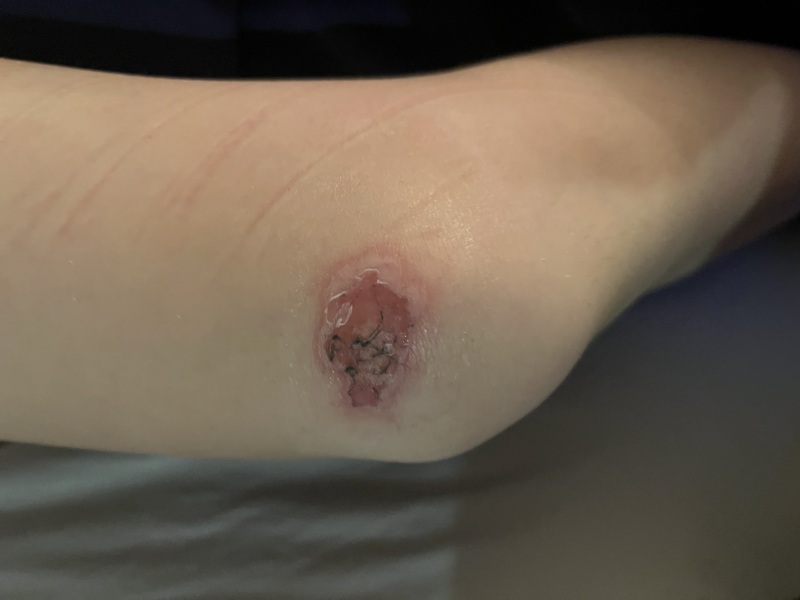 Does this wound look infected? Do I need to seek help tonight?