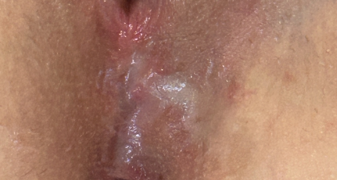 Third degree tear plus episiotomy scar revision (TW picture of scar)