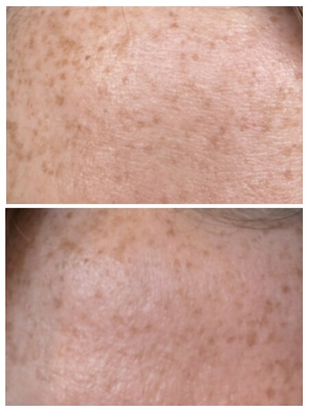 Tretinoin 0.006 - I think I can see an improvement already!! (Pic)