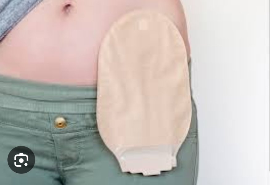 I have a stoma - AMA