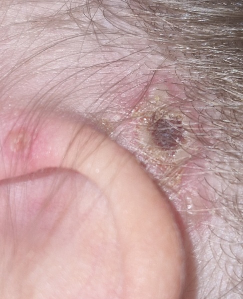 Infected chicken pox