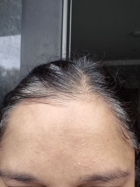 Tretinoin 0.006 - I think I can see an improvement already!! (Pic)