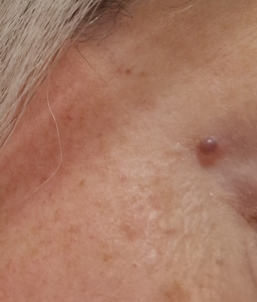 Weird bubble on face
