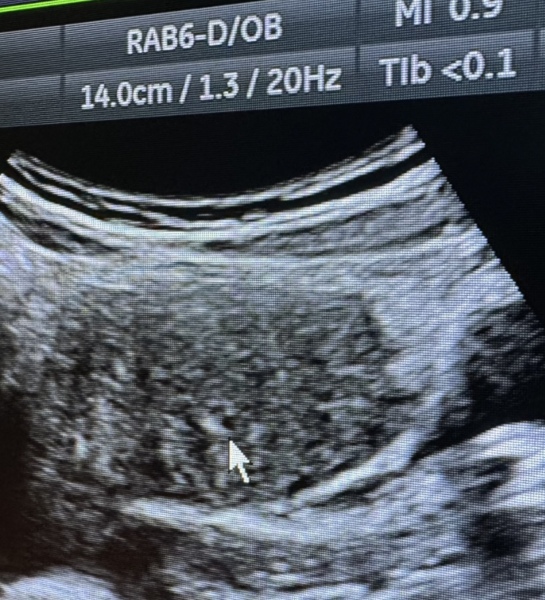 negative pregnancy test positive ultrasound