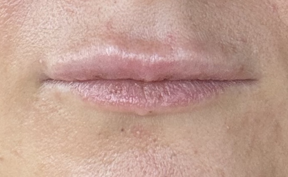 Uneven lip filler results ?!