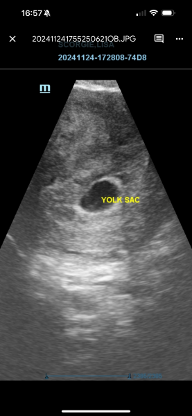 Early pregnancy scan worry