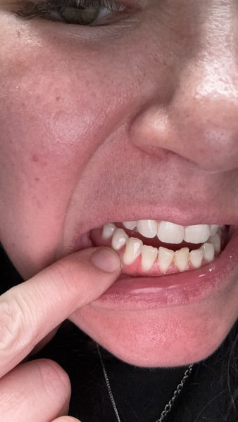 Health anxiety regarding teeth