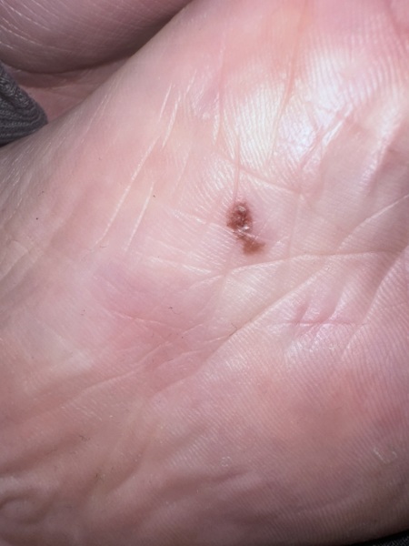 skin cancer?