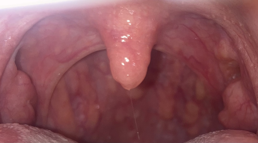 Does this throat look ok? (Horrible back of throat pic)