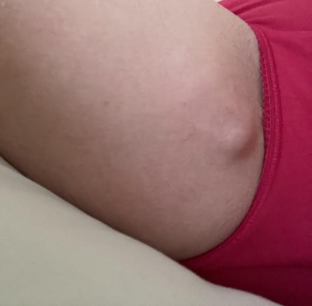 Would you get this lipoma removed? [pic of upper inner thigh]