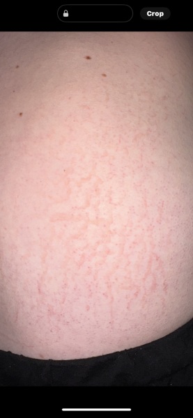 Sore rash/marks on back (photos)