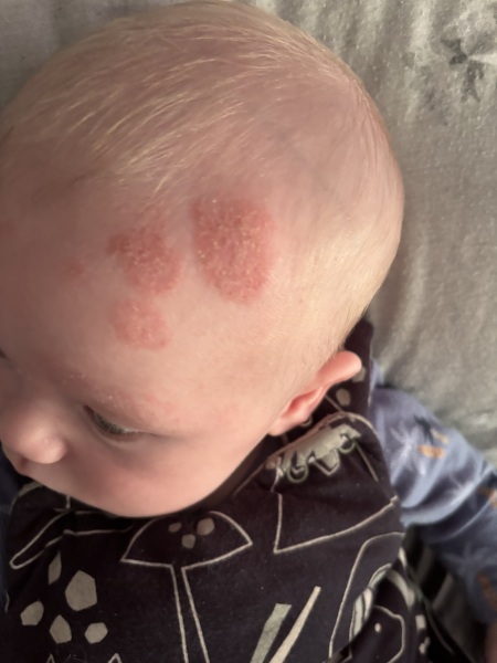 What is this on my sons head???