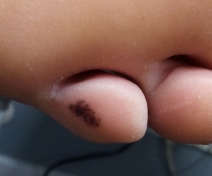 Melanoma on little toe? Picture attached.