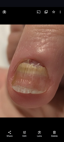 Infected nail aftermath help needed pic included