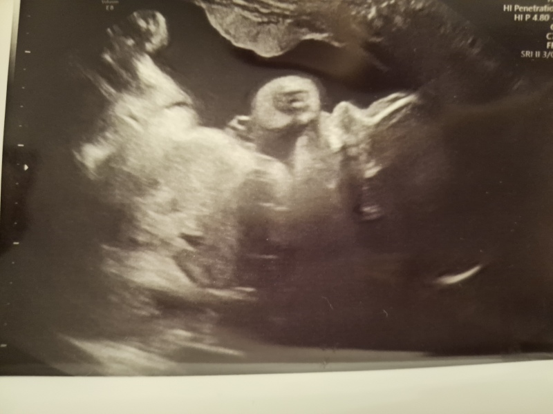 Boy or girl guesses from recent scan🙏 🥰