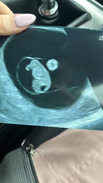 9wk early scan