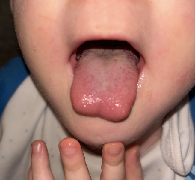Strep Throat/Scarlet Fever..or just viral illness
