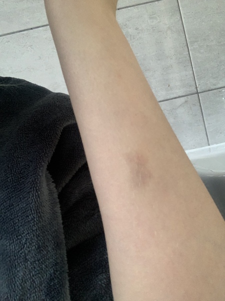 Bruise which hasn’t disappeared in over a year
