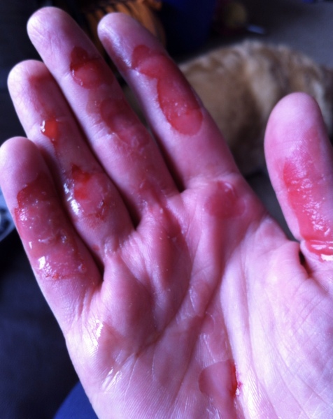 Had a nasty reaction to deep heat, not sure if I need to go to a&e or GP’s
