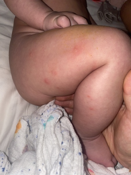 To ask what this rash is