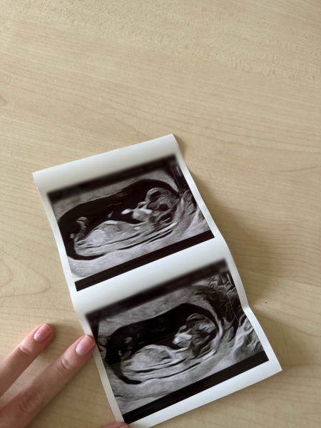 Boy or girl? Nub theory