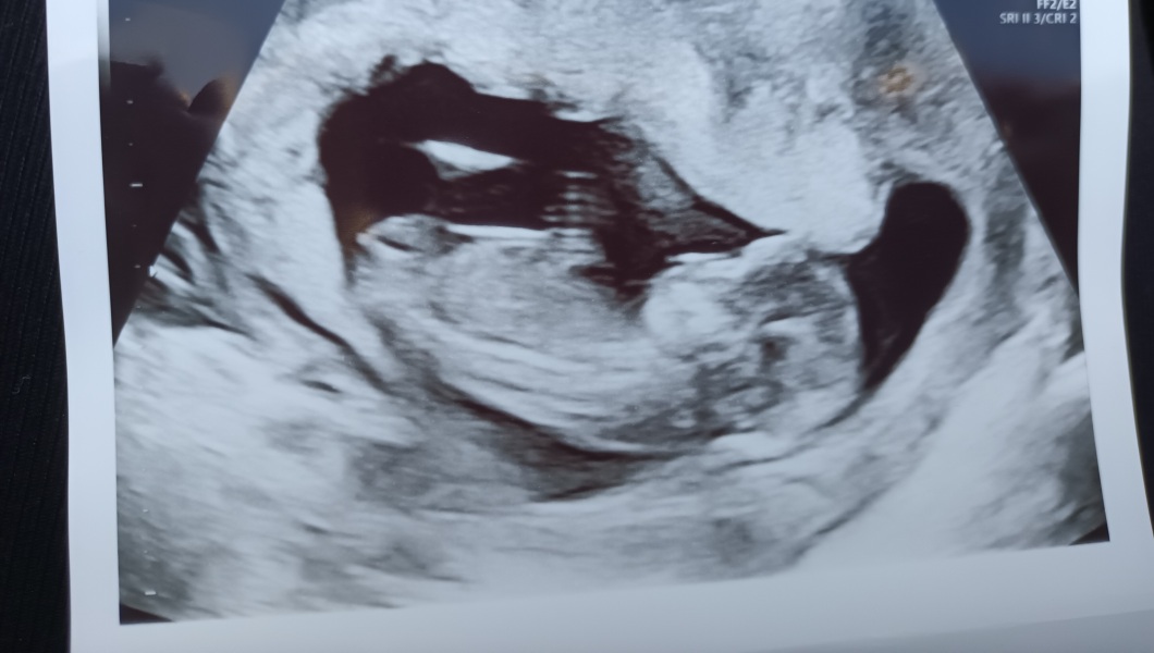 Baby scan gender
