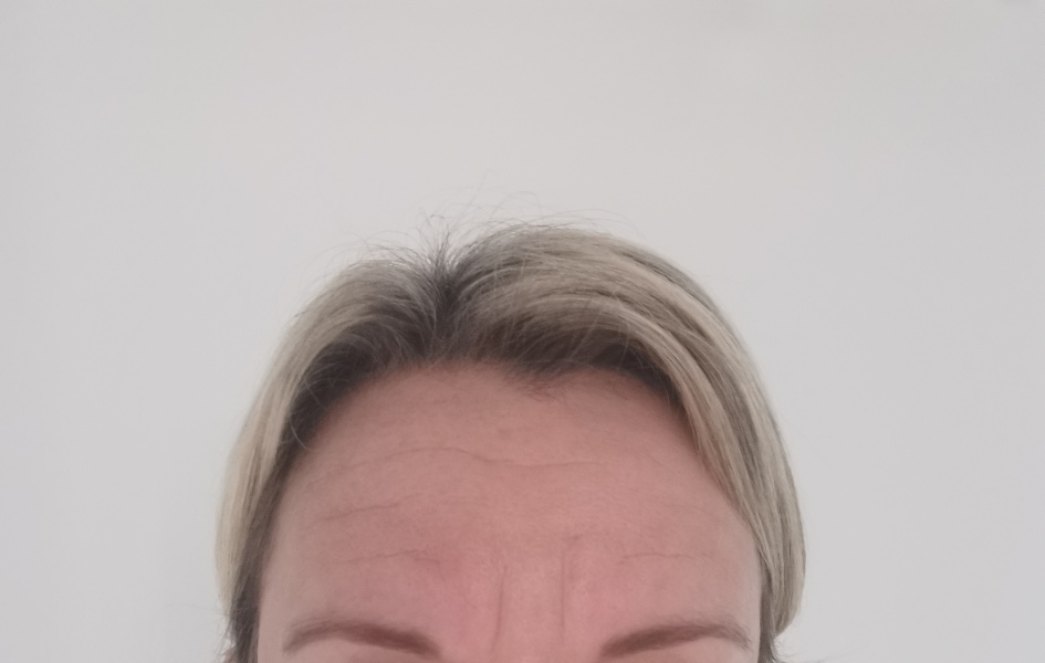 Will botex or anything help these forehead lines? ad