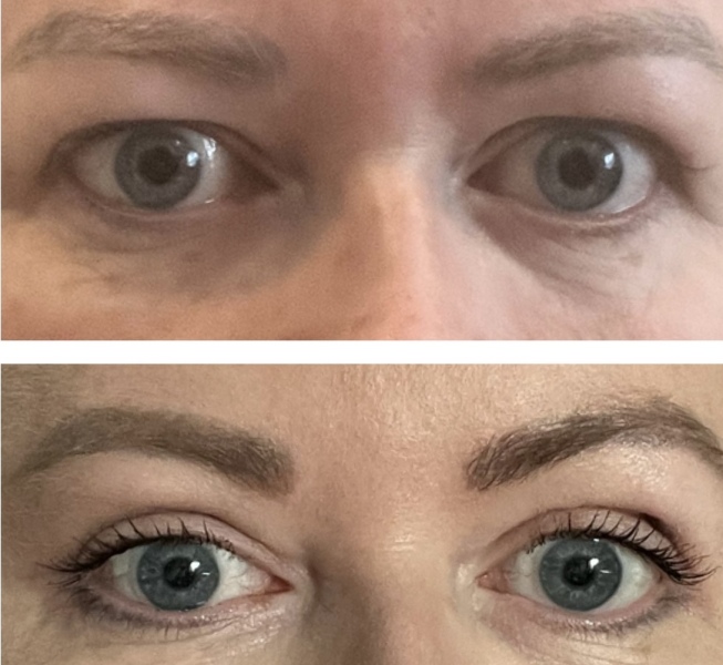 Blepharoplasty with local anesthesia