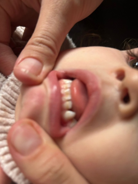 Teeth Health  Advice